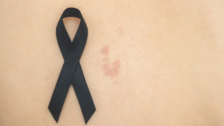 2 ndp dia europeo del cancer de piel 