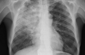 ep neumonia pulmonia radiografia pulmones