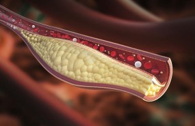 ep aterosclerosis placalas arterias ateroma trigliceridos colesterol