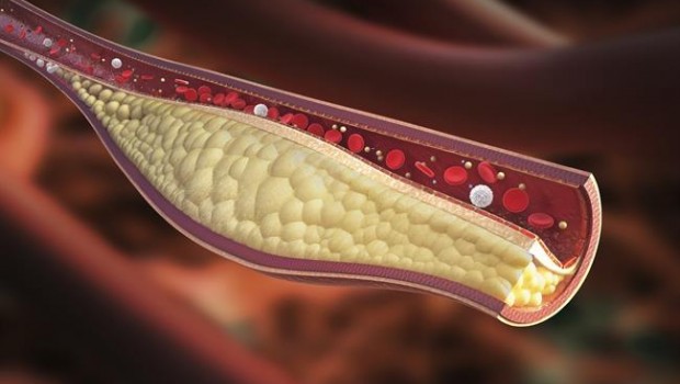 ep aterosclerosis placalas arterias ateroma trigliceridos colesterol