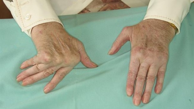 ep deformidad simetricaartritis reumatoide