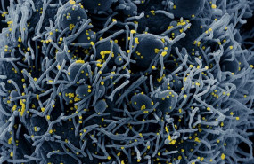 ep micrografia electronica de barrido coloreada de una celula apoptotica en azul infectada con