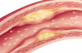 ep adherenciaslas arterias colesterol estatinas