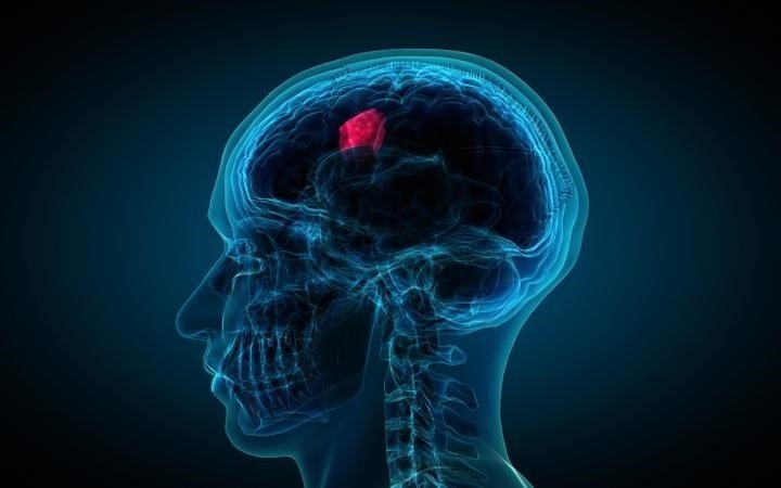 ep glioblastoma 20200504181705 ep glioblastoma 20200504181705