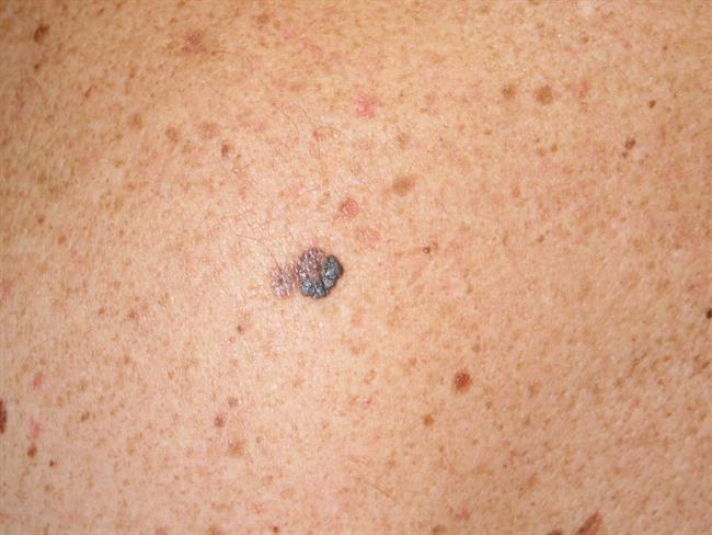 Melanoma | HM HOSPITALES ep melanoma 20170522165702