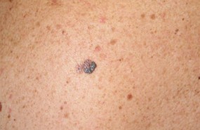 ep melanoma 20170522165702