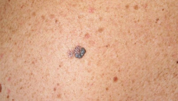 ep melanoma 20170522165702